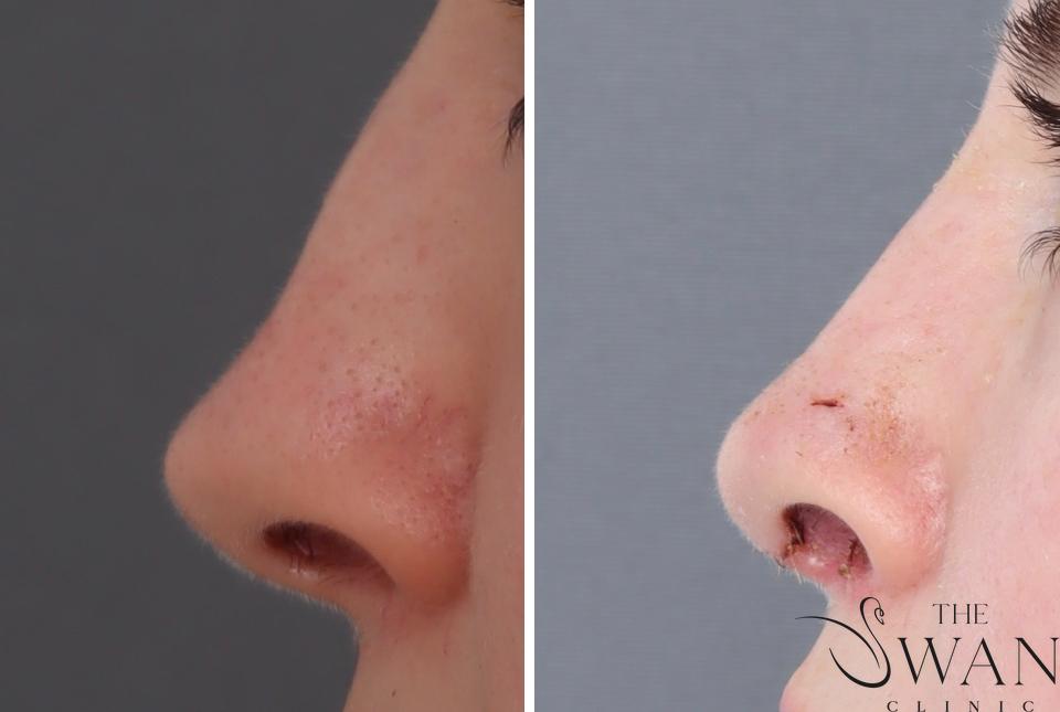 Rhinoplasty - Before and After