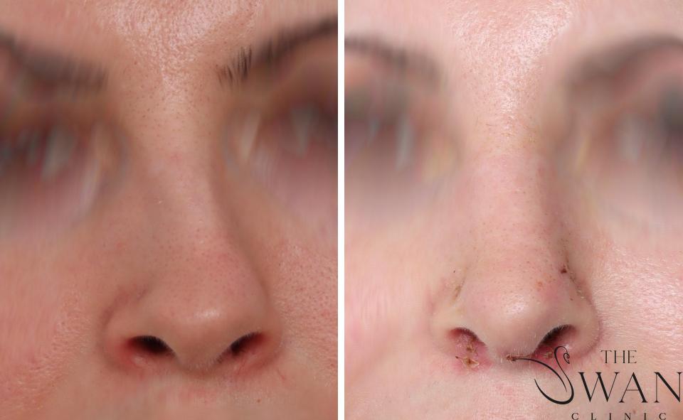 Rhinoplasty - Before and After