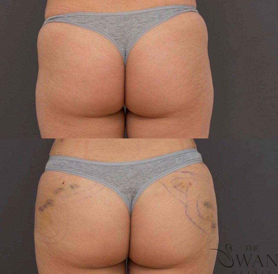 Vaser Liposuction - Before and After